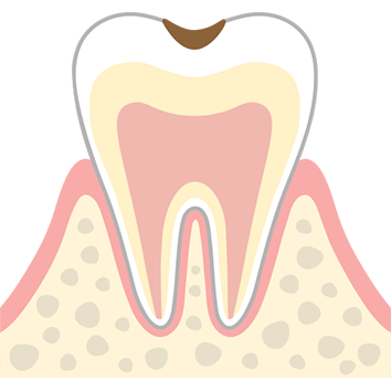 C1 初期の虫歯
