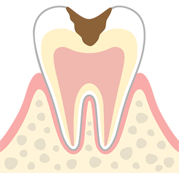 C2 歯の内部まで進行した虫歯