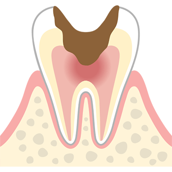 C2 神経まで進行した虫歯