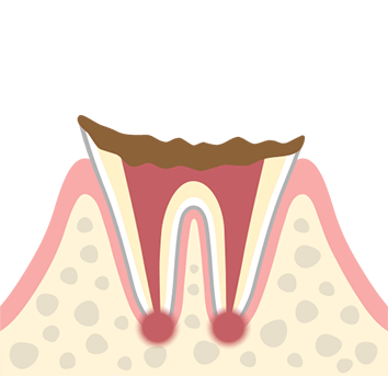 C2 根の部分だけが残った虫歯