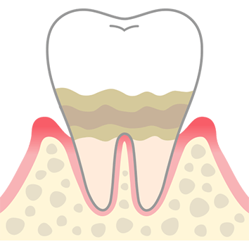 軽度歯周病